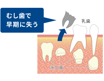 虫歯で早期に失う