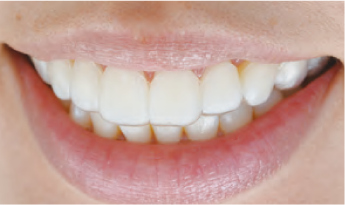 歯面にフィットしたトレーは透明性が高く、違和感なく使用いただけます